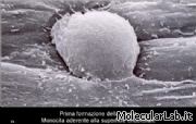 Placca aterosclerotica: adesione monocita