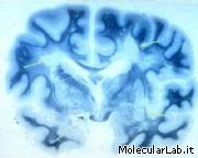 Cervello in paziente affetto da Sclerosi Multipla