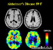 Effetti malattia Alzheimer