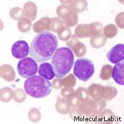 Cellule leucemiche