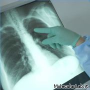 Cancro al polmone ai raggi X