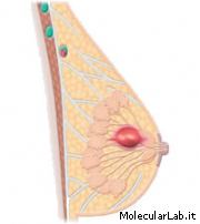 Formazione tumorigena in un seno