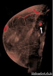 Tumore al seno visualizzato in 3D con MRI