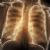 L'efficacia del pirfenidone sulla fibrosi polmonare idiopatica