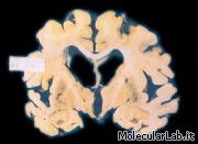 Sezione di cervello affetto da Alzheimer