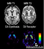 Analisi PET su cervello Parkinsoniano