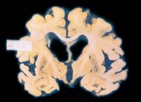 Sezione di cervello affetto da Alzheimer