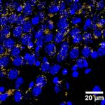 Nanoparticelle contro la beta-amiloide d'Alzhe