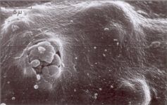 Lesione della placca che formera il trombo