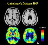 Effetti malattia Alzheimer